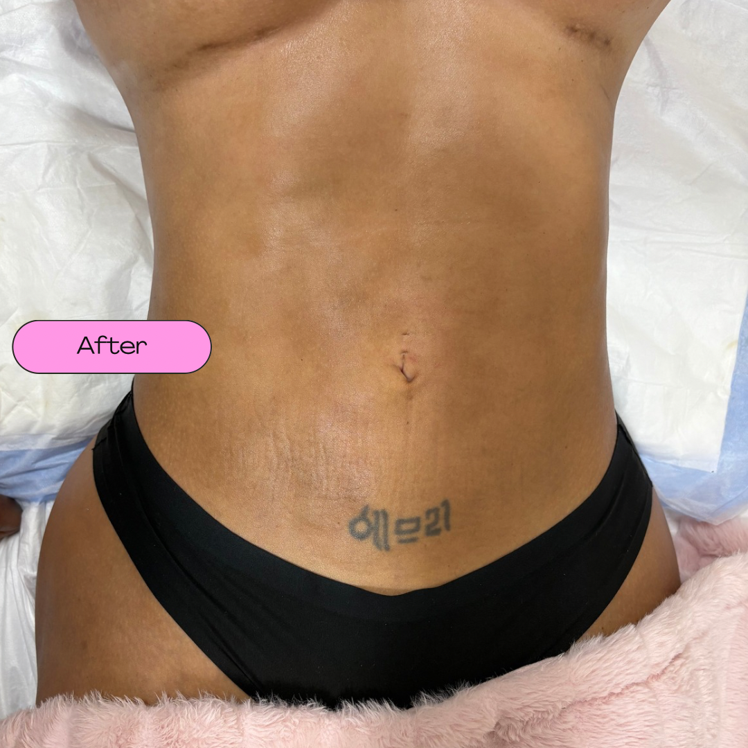 Mobile Post-op Massages *DEPOSITS ONLY*